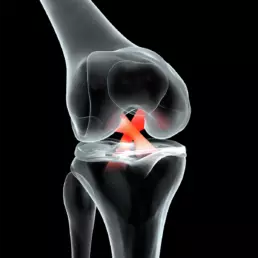 acl injury orthopaedic nairobi kenya