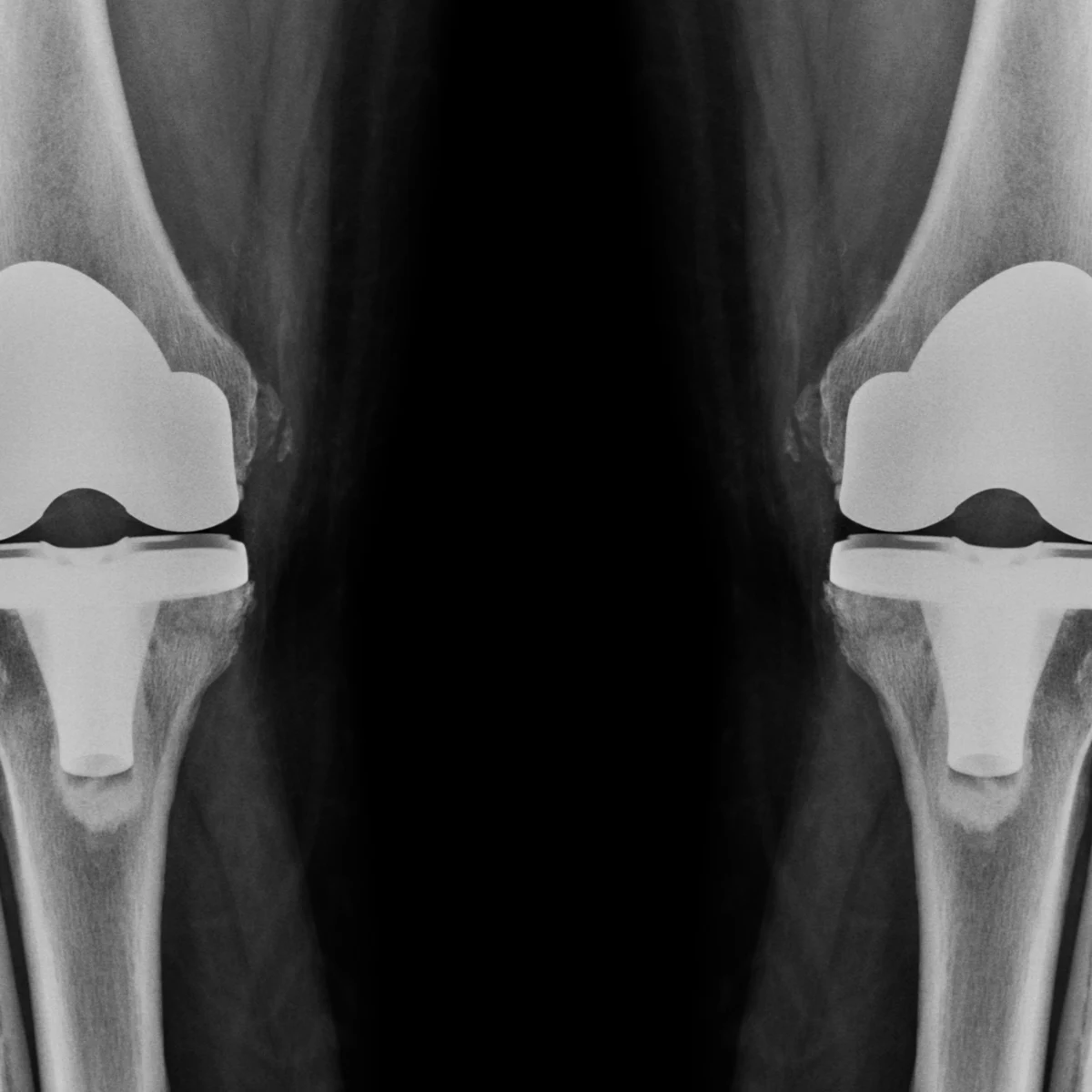 bilateral knee replacement surgery kenya