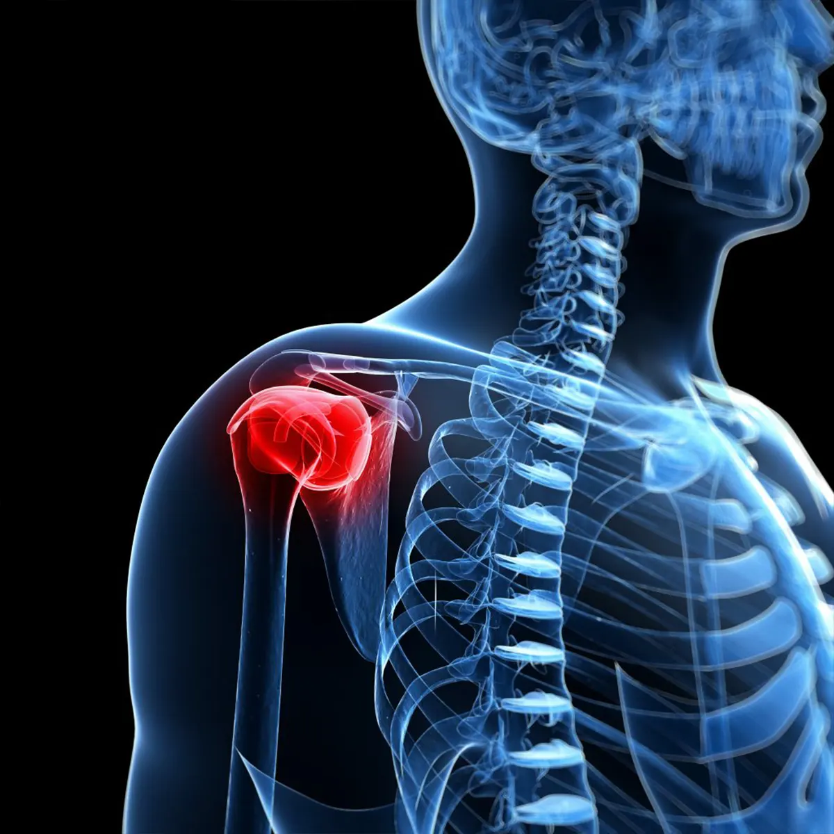 Frozen Shoulder (Adhesive Capsulitis)