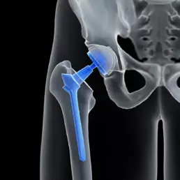 hip replacement surgery in kenya