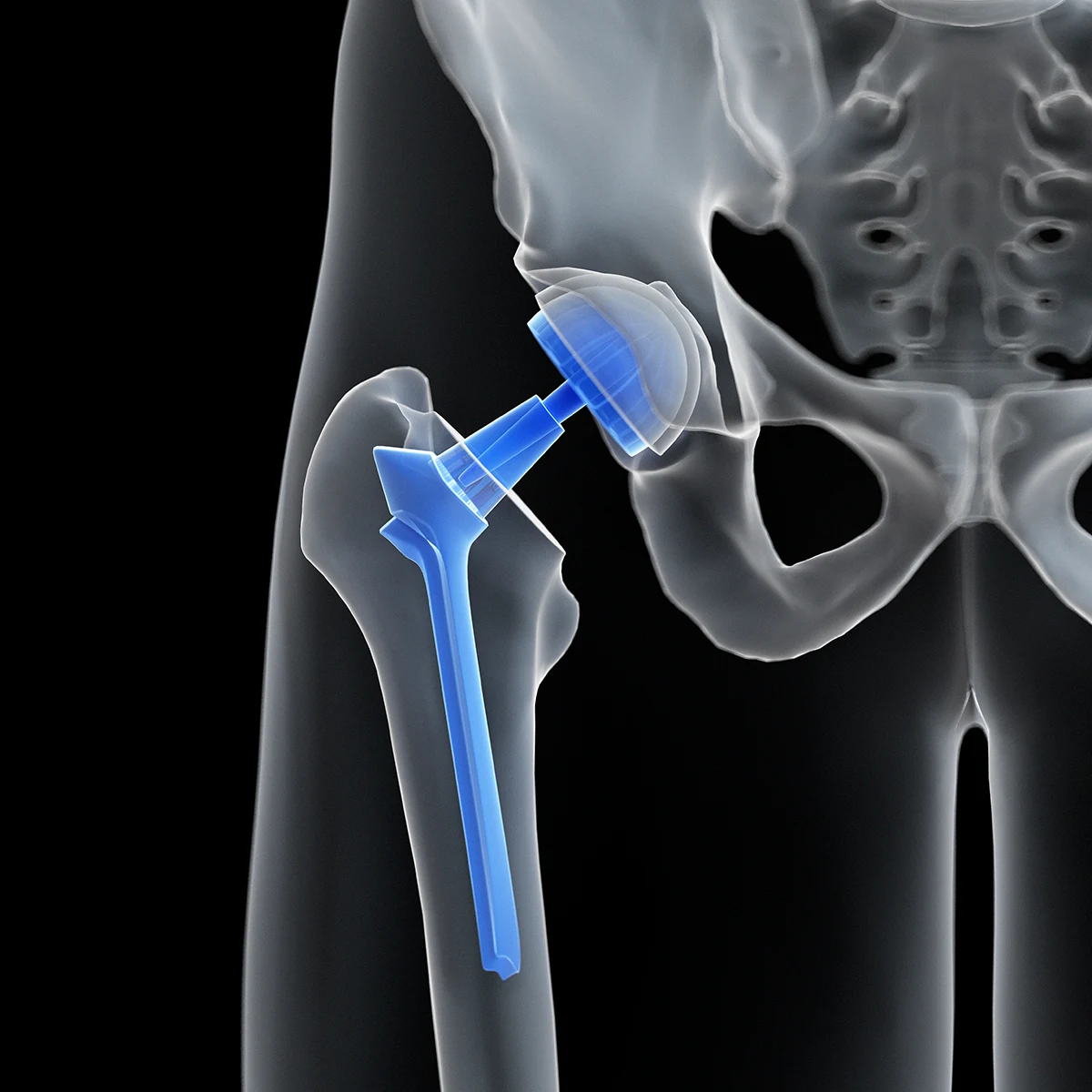 hip replacement surgery in kenya