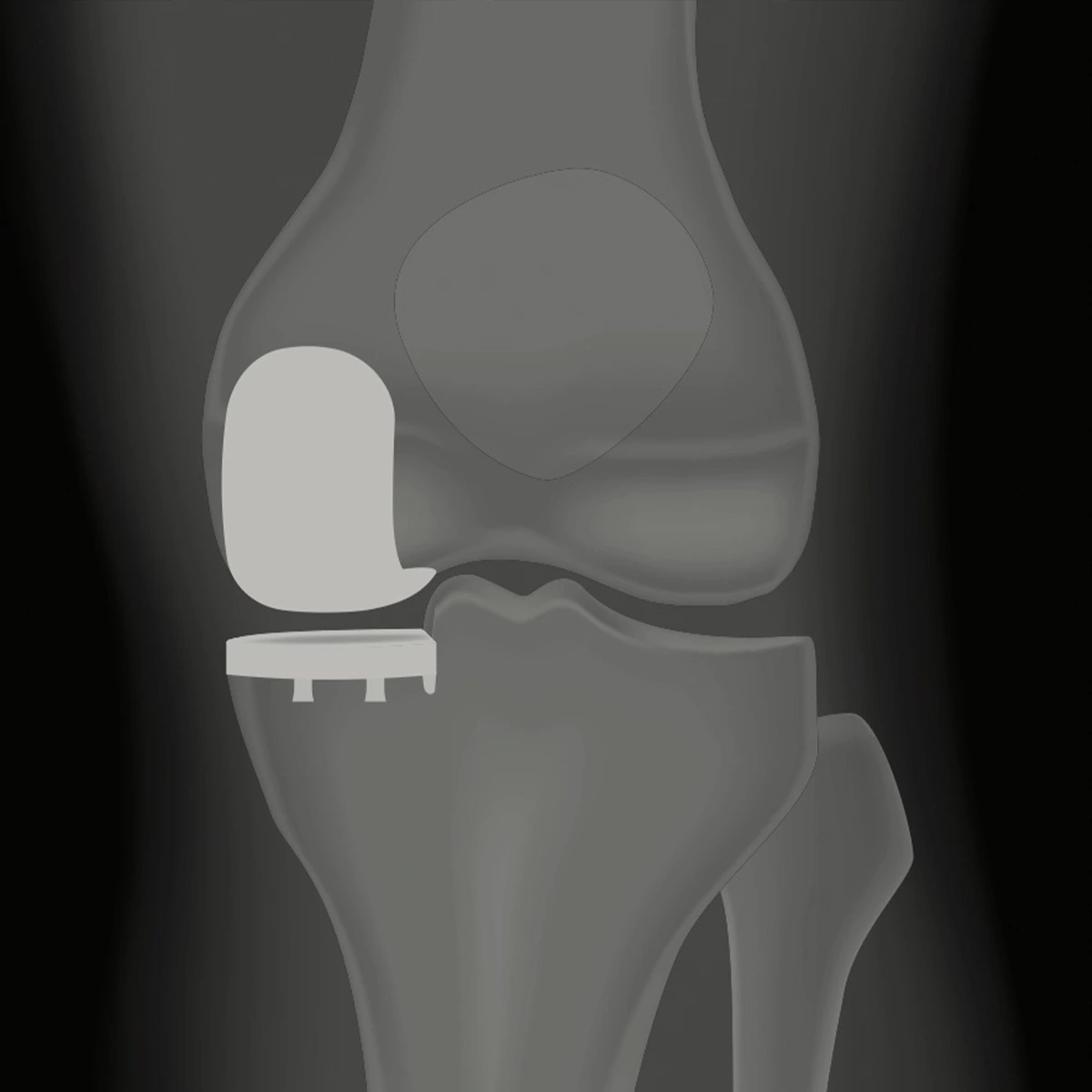 partial knee replacement in nairobi