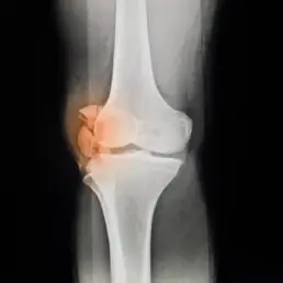 patella fracture treatment in nairobi